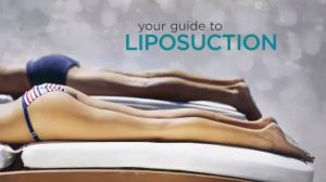 Liposuction Surgery Guide