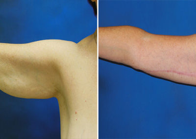 Arm Lift Before and After 3