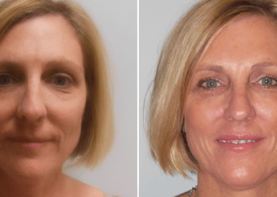 Face Lift Before After 2